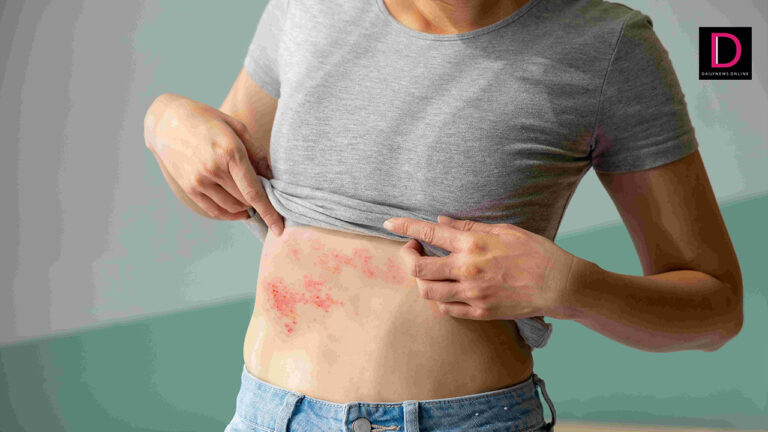 Shingles