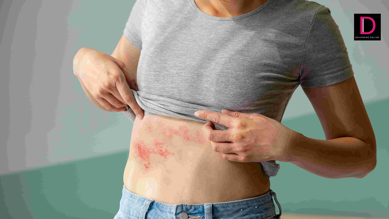 Shingles