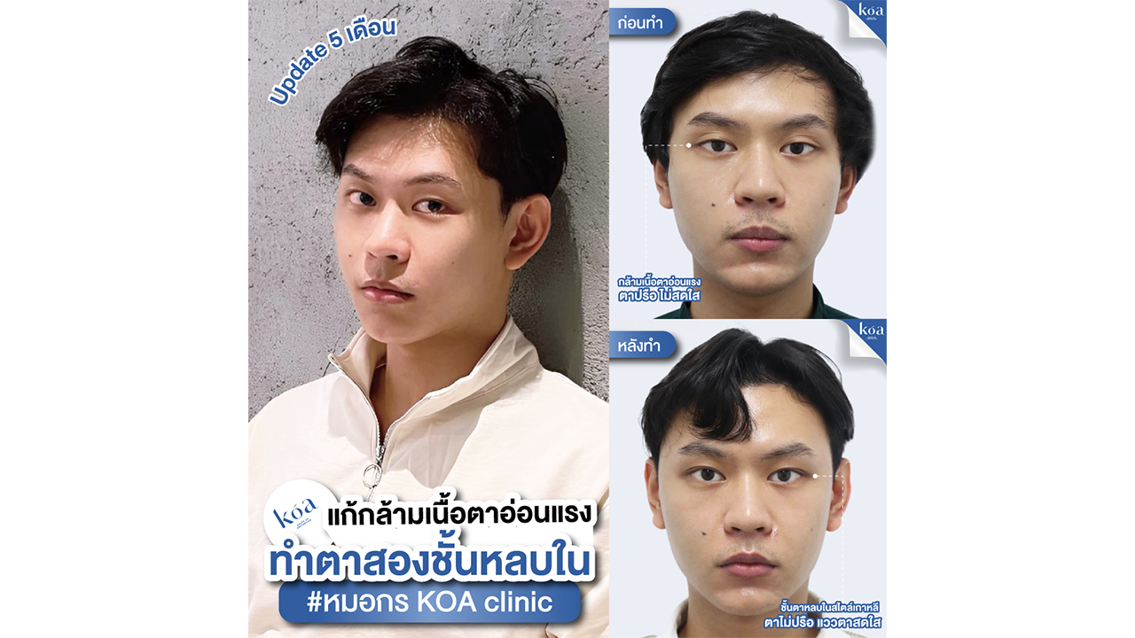 ภาวะกล้ามเนื้อตาอ่อนแรง (Ptosis)