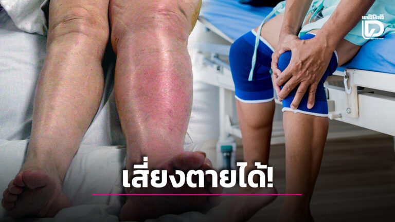 โรคขาบวมแดง