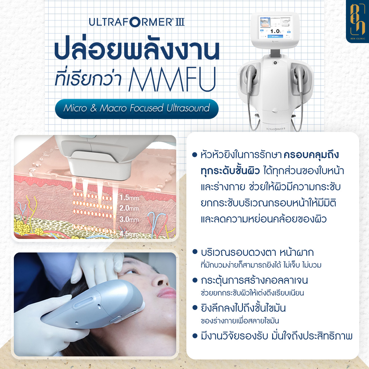 Ultraformer III ช่วยเรื่องอะไร