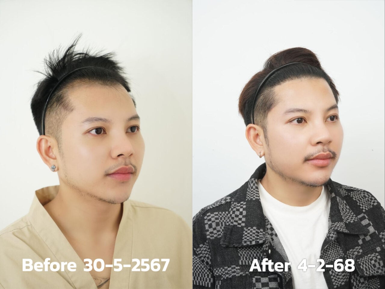 fue hair transplant