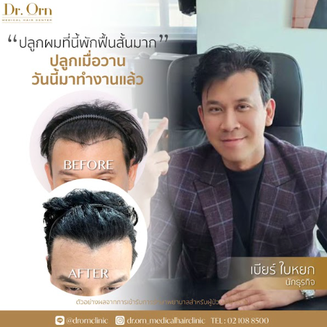 ศัลยกรรมปลูกผม