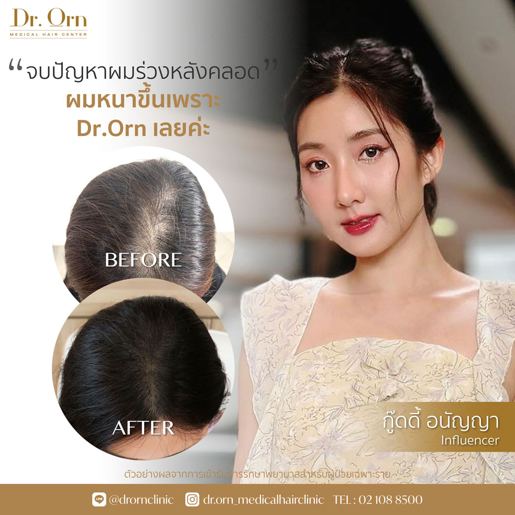 ปลูกผม รีวิว
