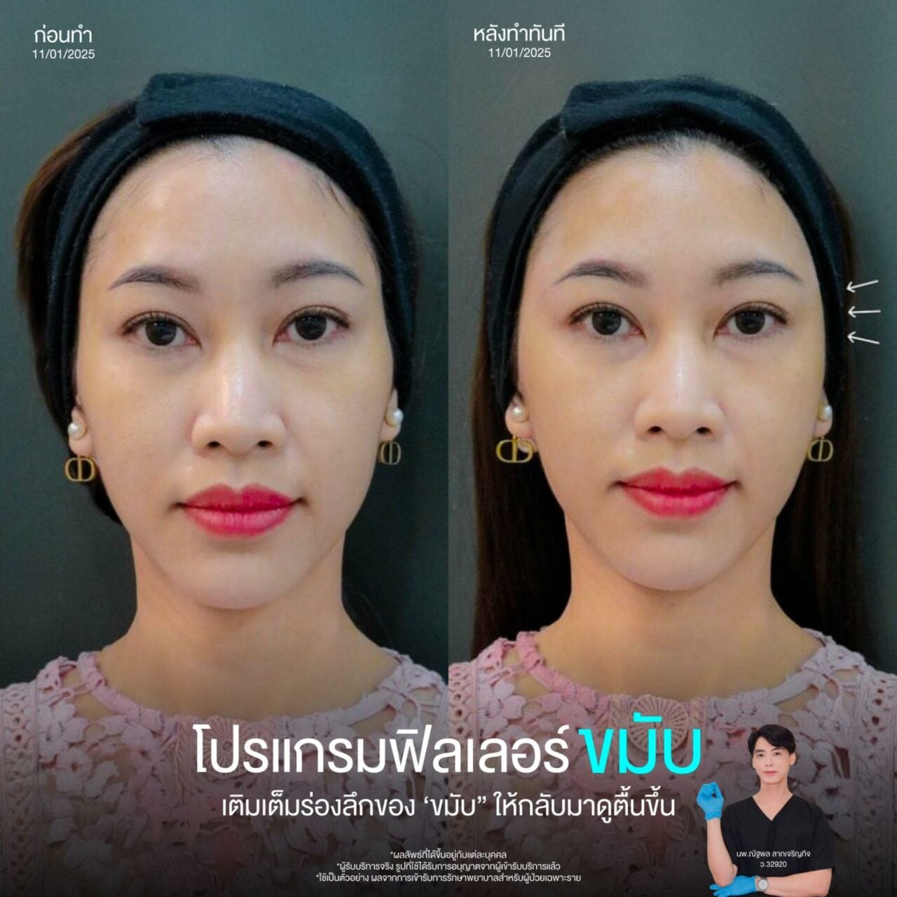 รีวิวฉีดฟิลเลอร์ขมับ