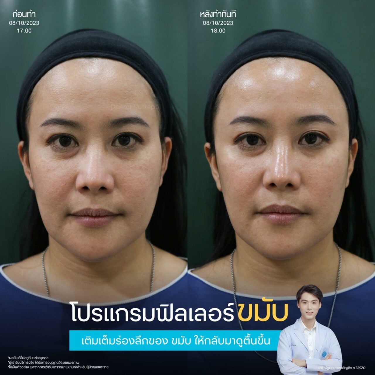 ฉีดฟิลเลอร์ขมับ