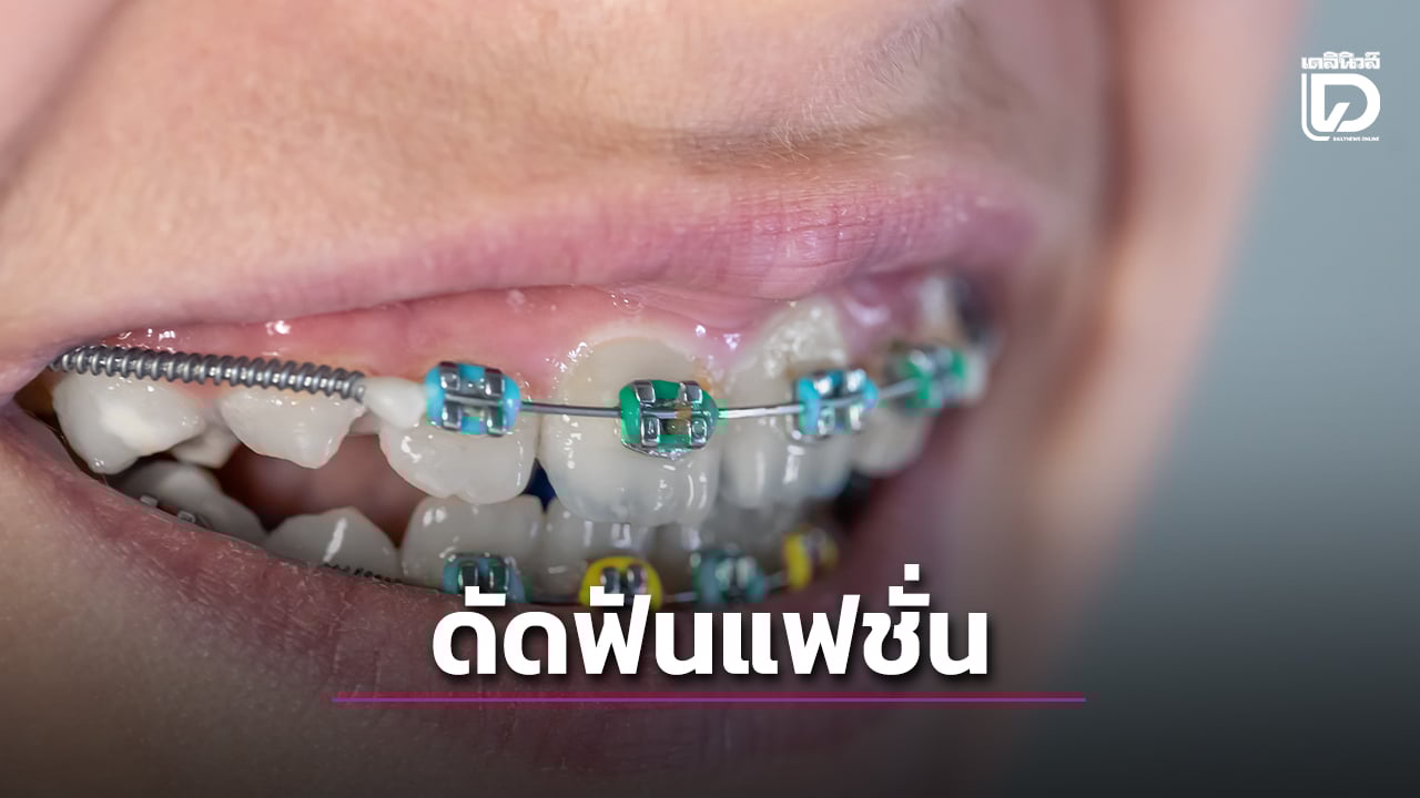 .เช็กลิสต์อันตรายจาก 'จัดฟันแฟชั่น'.