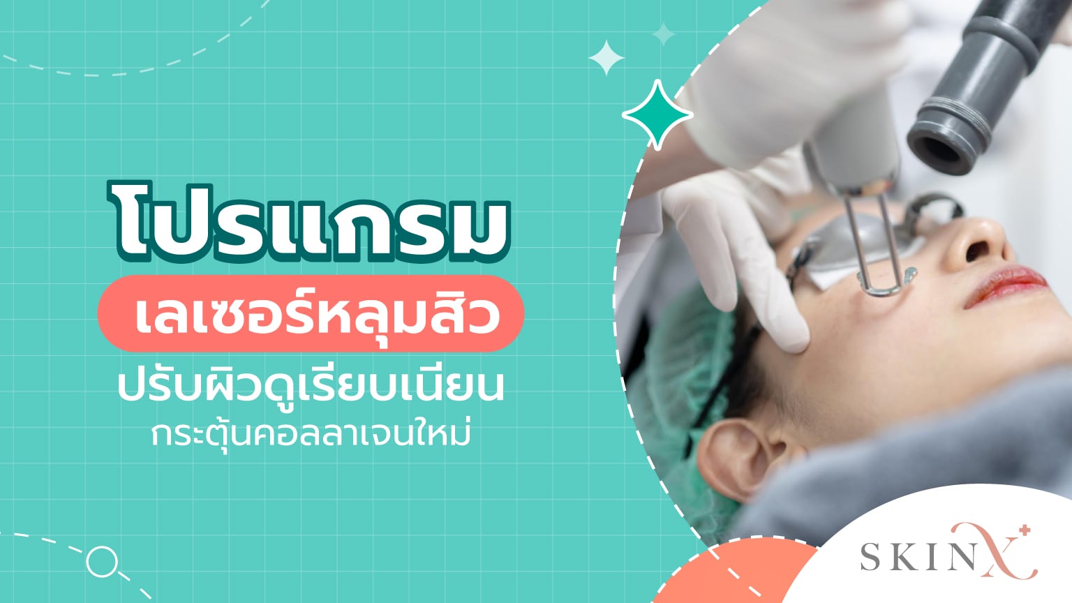 เลเซอร์หลุมสิว