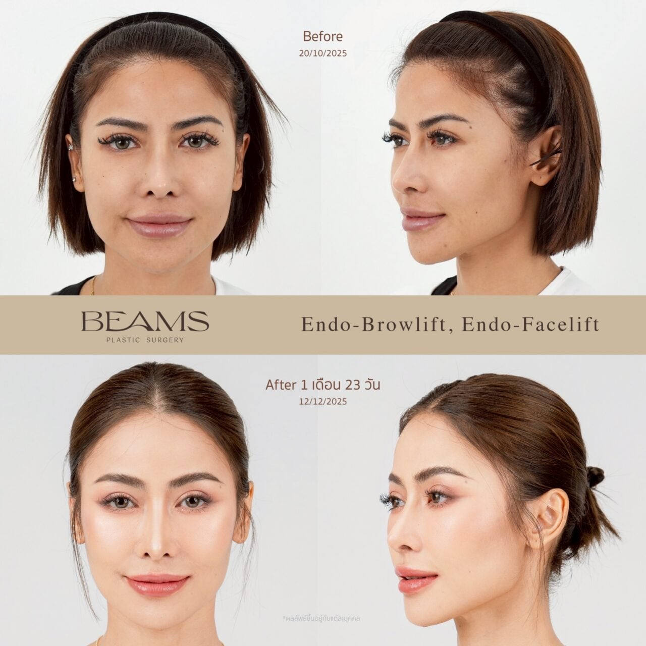 รีวิวส่องกล้องดึงหน้าคุณปลา