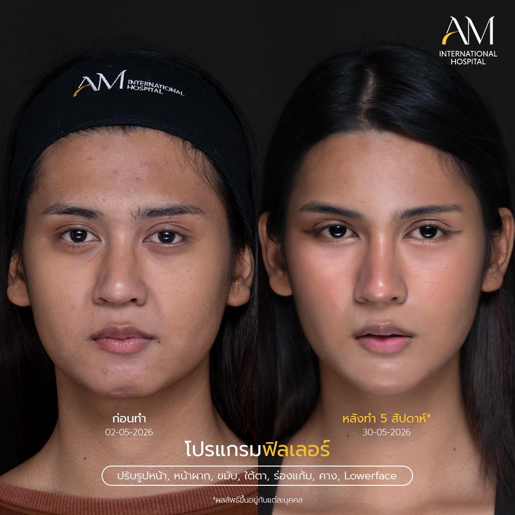 คุณลูกพลับหลังทำโปรแกรมฟิลเลอร์ปรับรูปหน้าวันที่ 30/05/69