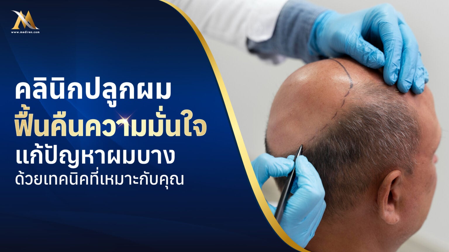 คลินิกปลูกผม
