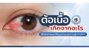 ต้อเนื้อ วิธีรักษา